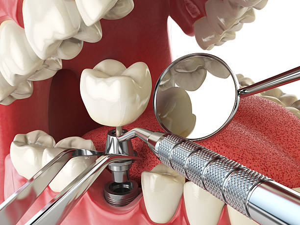 Best Emergency Dentist for Knocked-Out Tooth in Hitchcock, TX